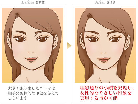 輪郭形成の症例写真 手術前/手術後