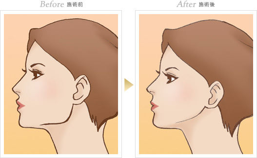 輪郭形成の症例写真 手術前/手術後