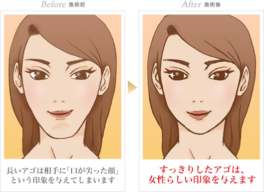 輪郭形成の症例写真 手術前/手術後