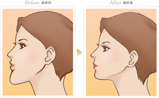 輪郭形成の症例写真 手術前/手術後
