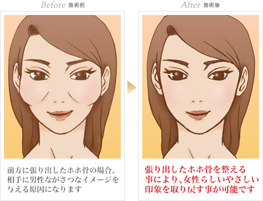 輪郭形成の症例写真 手術前/手術後