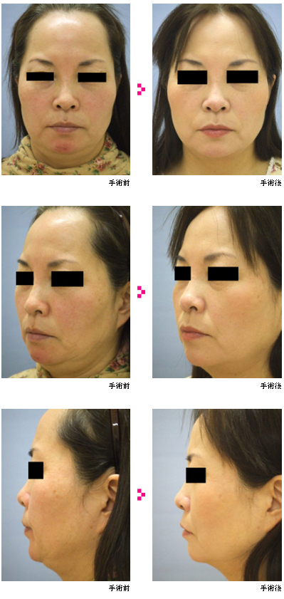 サーマクールの症例写真 手術前/手術後