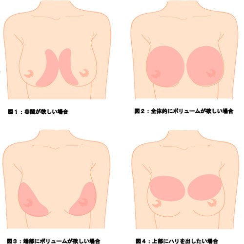 四日市 ヒアルロン酸豊胸 城本クリニック四日市院
